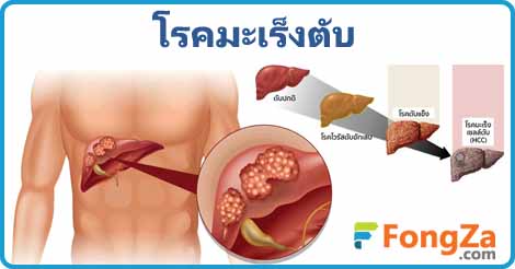 โรคมะเร็งตับ มะเร็ง การรักษามะเร็งตับ โรคไม่ติดต่อ