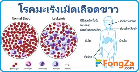 มะเร็งเม็ดเลือดขาว ลูคีเมีย โรคมะเร็ง รักษาลูเคีเมีย