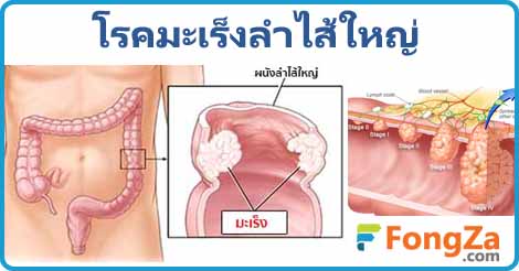 มะเร็งลำไส้ใหญ่ โรคทางเดินอาหาร โรคไม่ติดต่อ โรคมะเร็ง