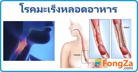 มะเร็งหลอดอาหาร โรคมะเร็ง โรคไม่ติดต่อ โรคทางเดินอาหาร