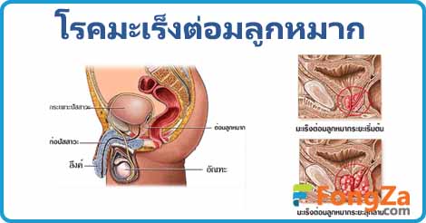 มะเร็งต่อมลูกหมาก โรคผู้ชาย โรคมะเร็ง โรคไม่ติดต่อ