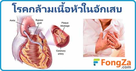 กล้ามเนื้อหัวใจอักเสบ โรคหัวใจ โรคติดเชื้อ โรคหัวใจอักเสบ