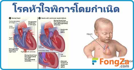 หัวใจพิการโดยกำเนิด โรคเด็ก โรคหัวใจ โรคหัวใจพิการแต่กำเนิด