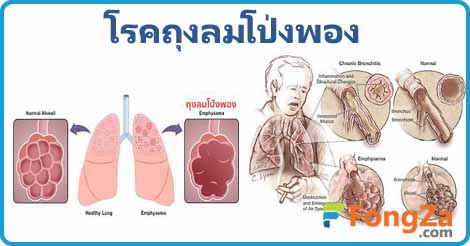 โรคถุงลมโป่งฟอง โรคปอด โรคระบบทางเดินหายใจ โรคไม่ติดต่อ