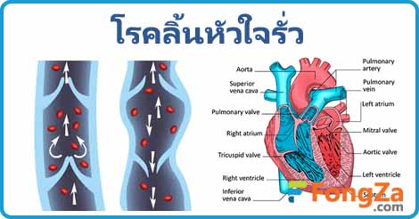 ลิ้นหัวใจรั่ว โรคหัวใจ โรคไม่ติดต่อ