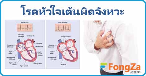 หัวใจเต้นผิดปรกติ หัวใจเต้นผิดจังหวะ โรคหัวใจ