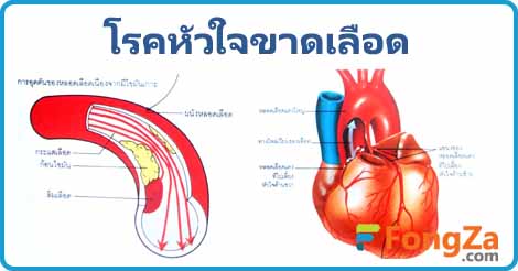 หัวใจขาดเลือด กล้ามเนื้อหัวใจขาดเลือด โรคหัวใจ