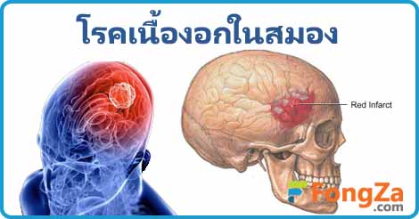 เนื้องอกในสมอง โรคสมอง โรคเนื้องอก โรคไม่ติดต่อ