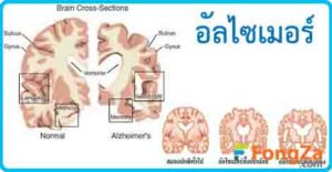 อัลไซเมอร์ โรคสมองเสื่อม โรคระบบประสาทและสมอง