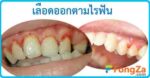 เลือดออกตามไรฟัน ลักปิดลักเปิด โรคในช่องปาก