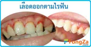 เลือดออกตามไรฟัน ลักปิดลักเปิด โรคในช่องปาก